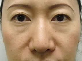 目の下のクマ・タルミ症例手術前（メイクあり）