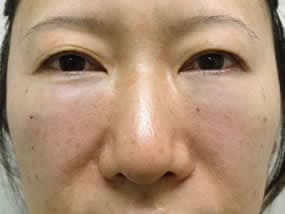 目の下のクマ・タルミ症例手術直後（メイクなし）