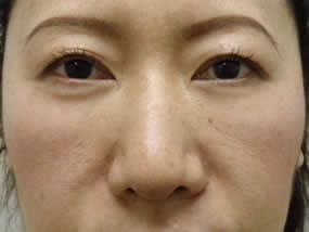 目の下のクマ・タルミ症例手術２週間後（メイクあり）