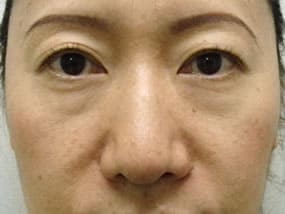 目の下のクマ・タルミ症例手術前