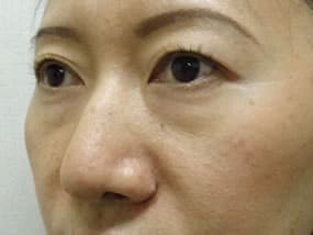 目の下のクマ・タルミ症例手術前