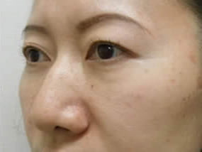 目の下のクマ・タルミ症例手術３ヶ月後