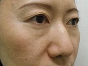 目の下のクマ・タルミ症例手術前