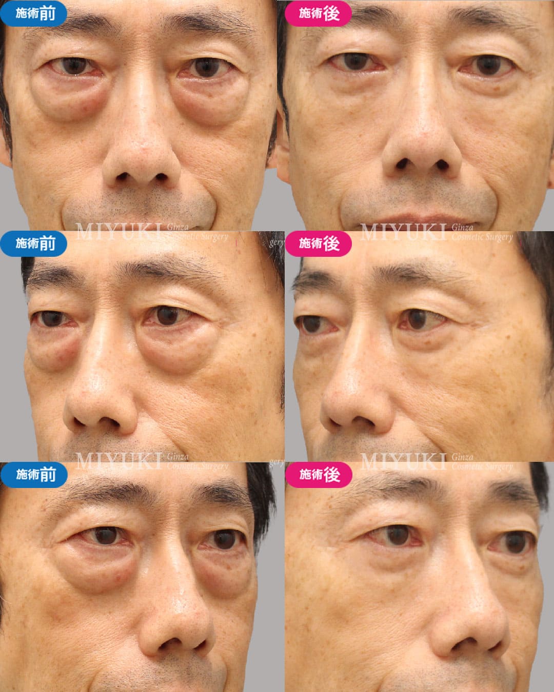 目の下のくま症例470の治療画像