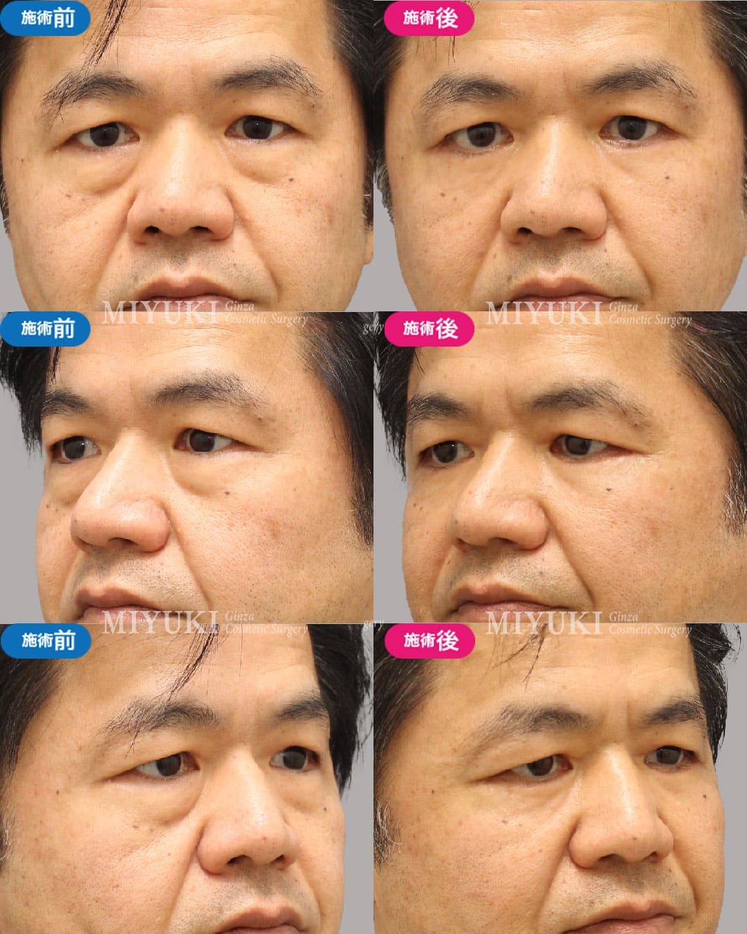 目の下のくま症例471の治療画像