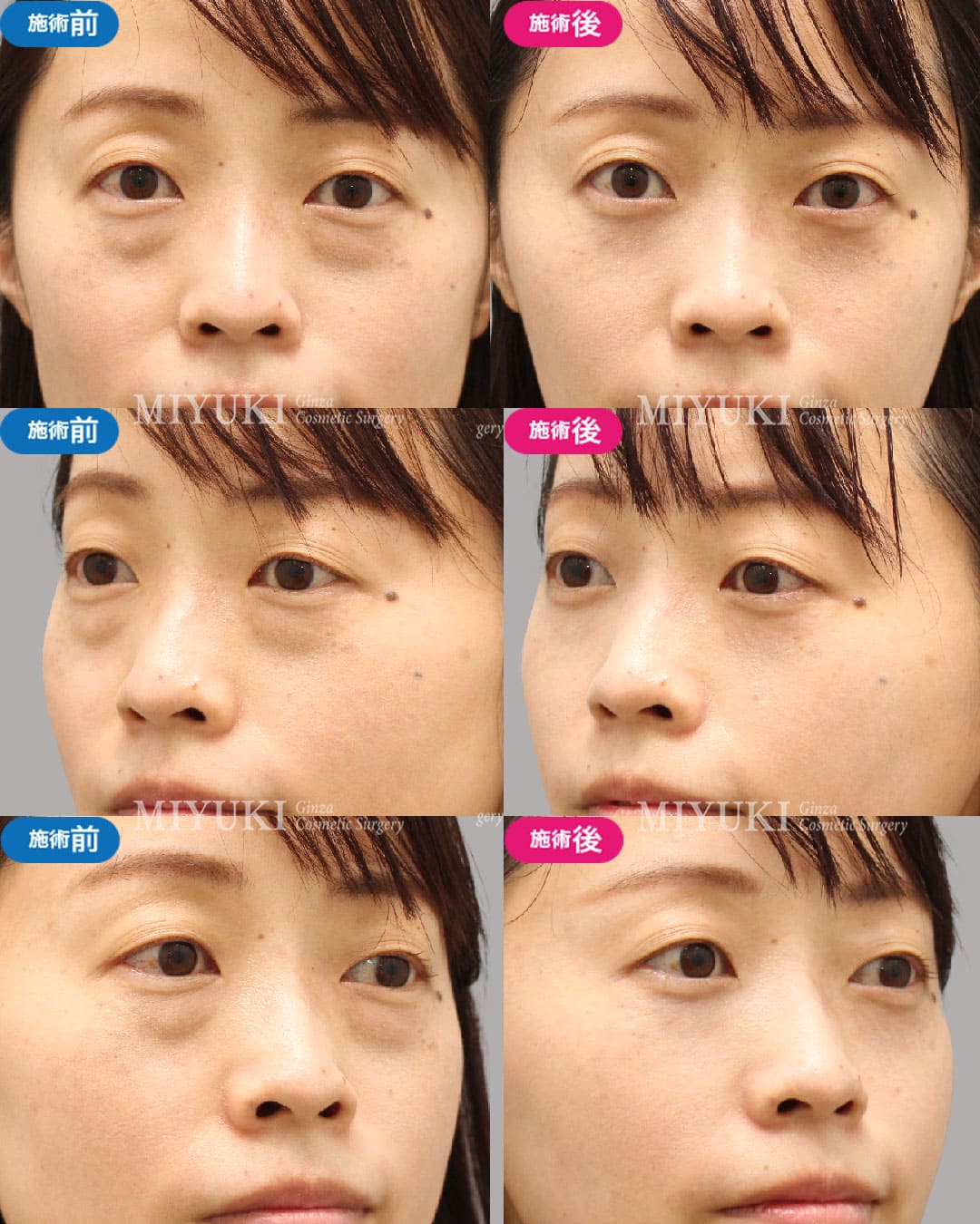 目の下のくま症例472の治療画像