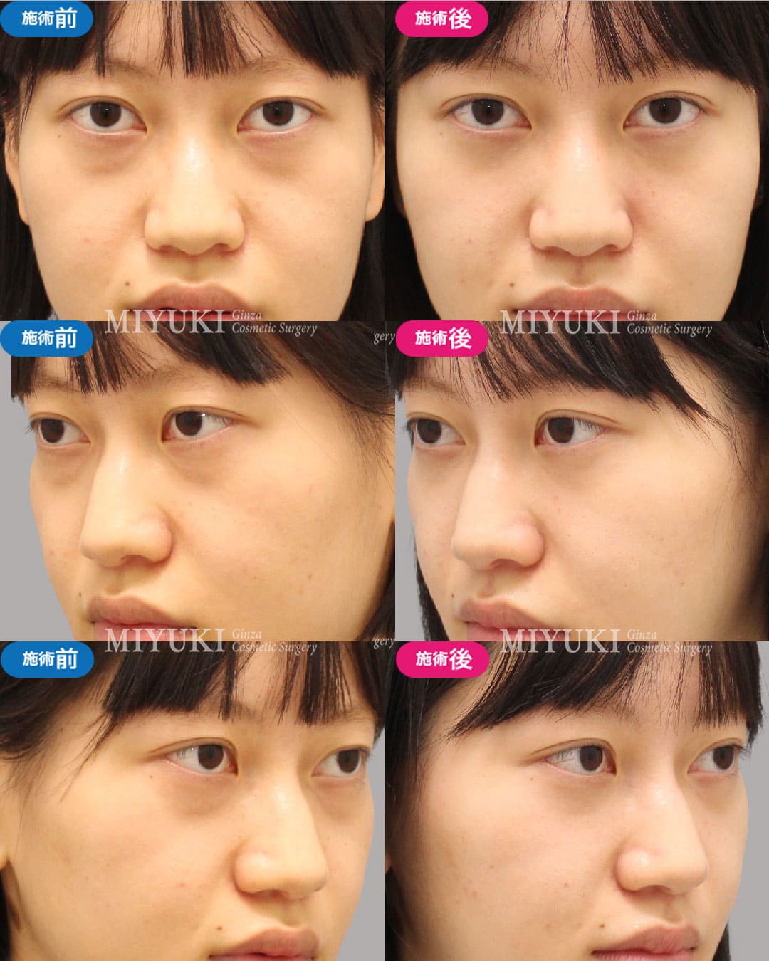 目の下のくま症例473の治療画像