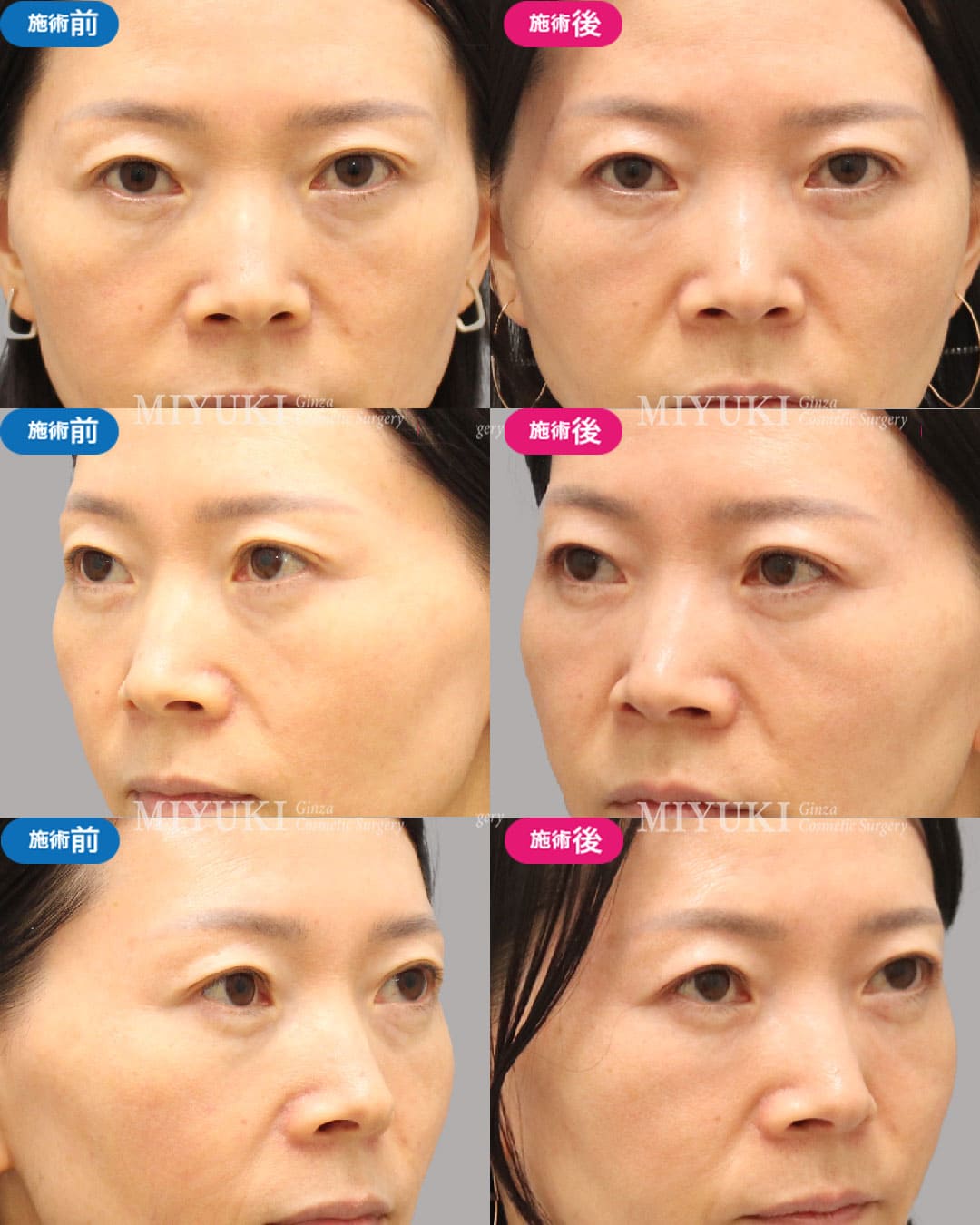 目の下のくま症例474の治療画像