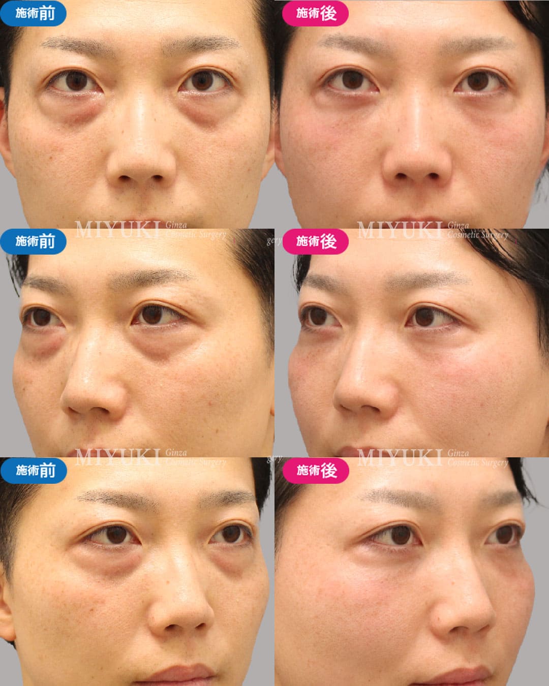 目の下のくま症例475の治療画像