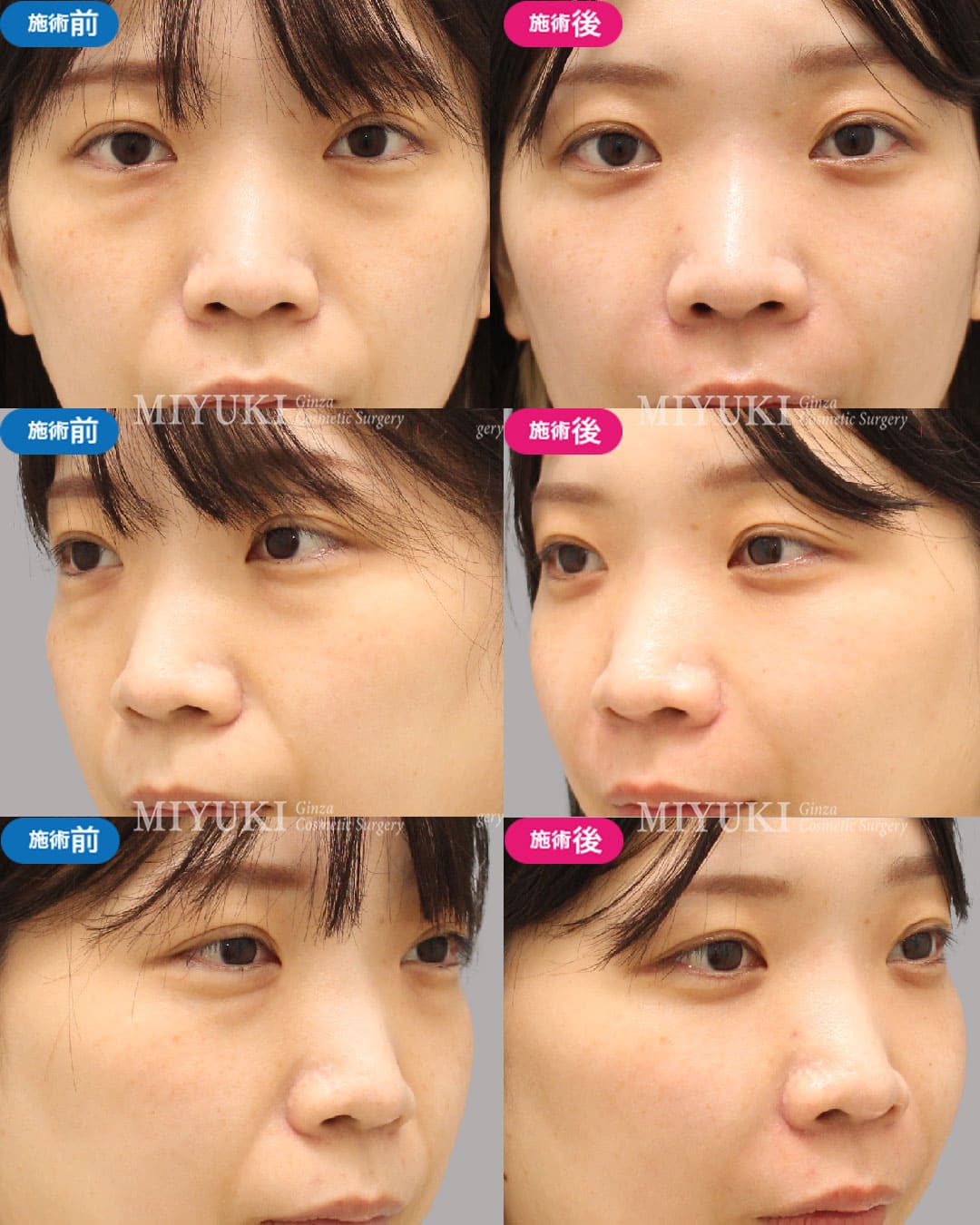 目の下のくま症例476の治療画像