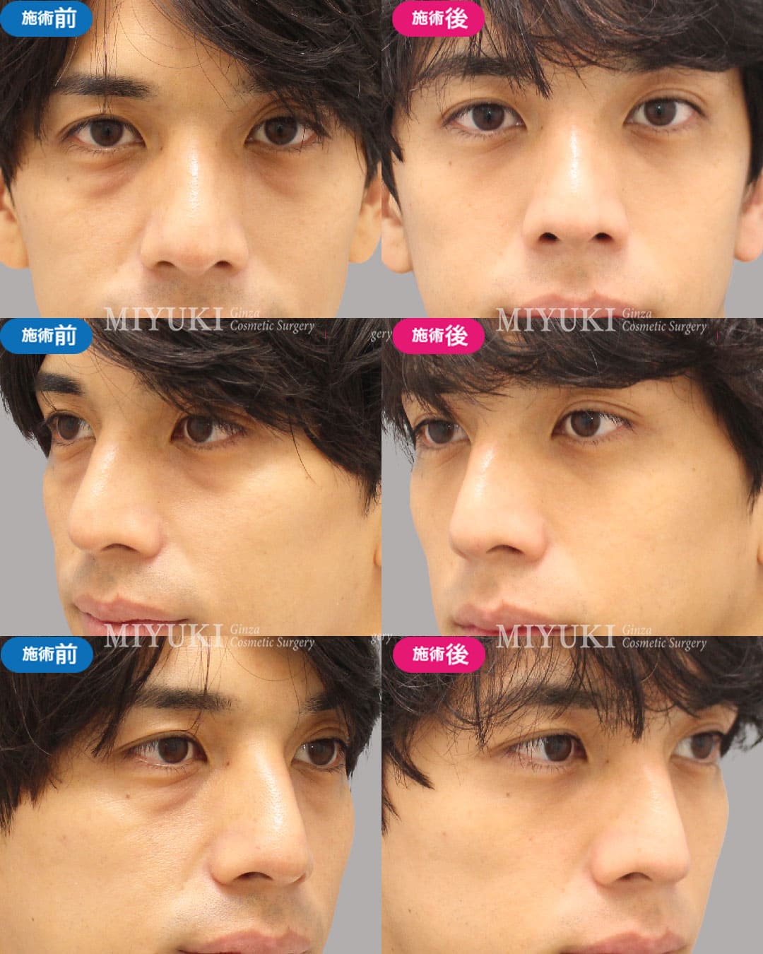 目の下のくま症例477の治療画像