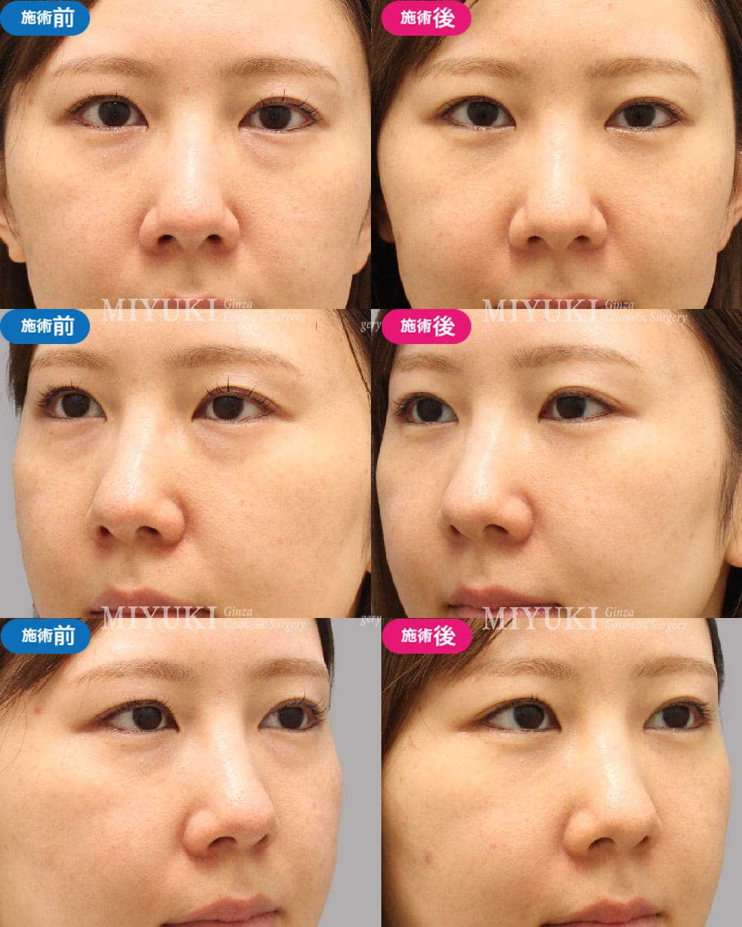 目の下のくま症例478の治療画像