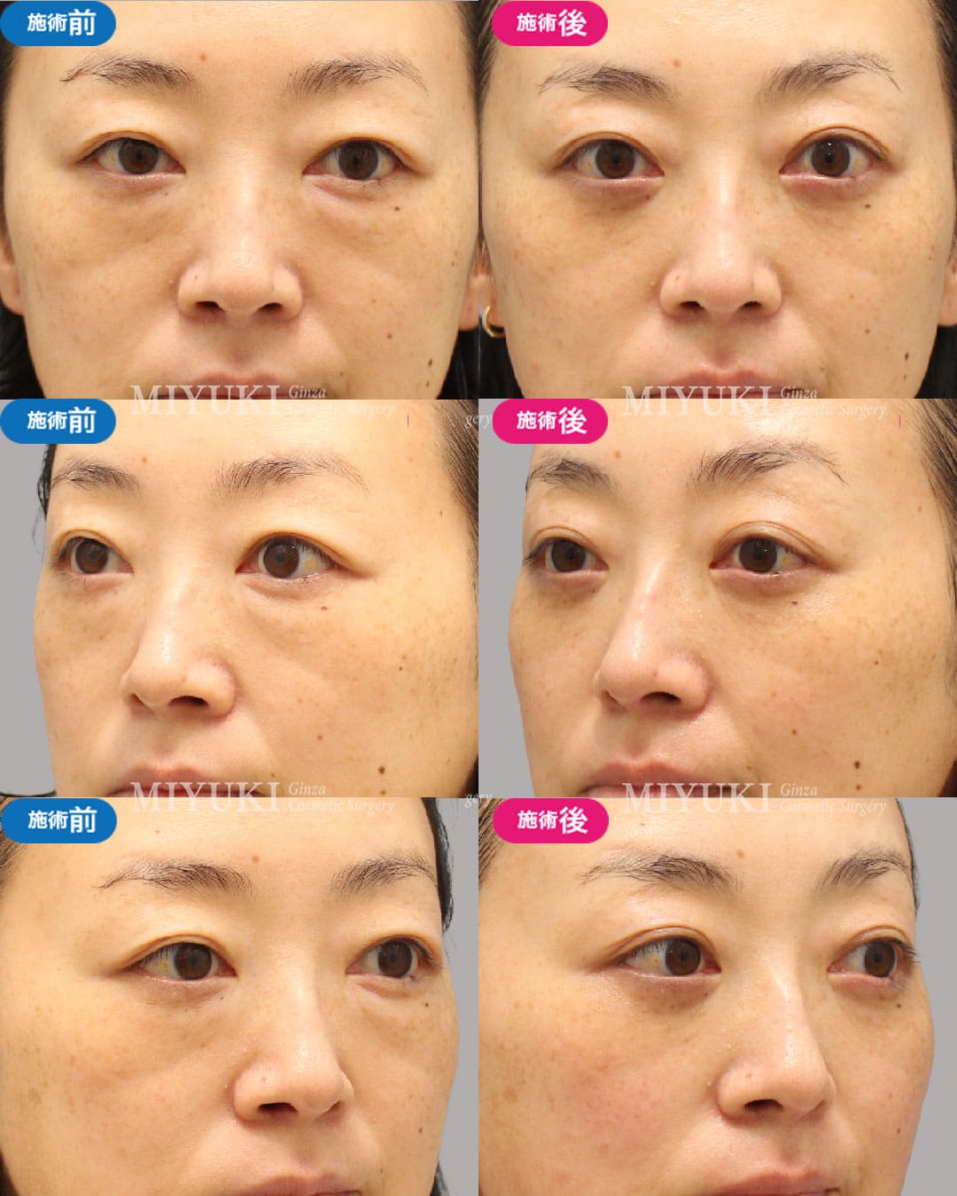 目の下のくま症例479の治療画像