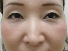 目の下のクマ・タルミ症例手術３ヶ月後