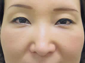 目の下のクマ・タルミ症例手術１ヵ月後（メイクあり）