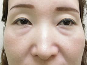 目の下のクマ・タルミ症例手術前