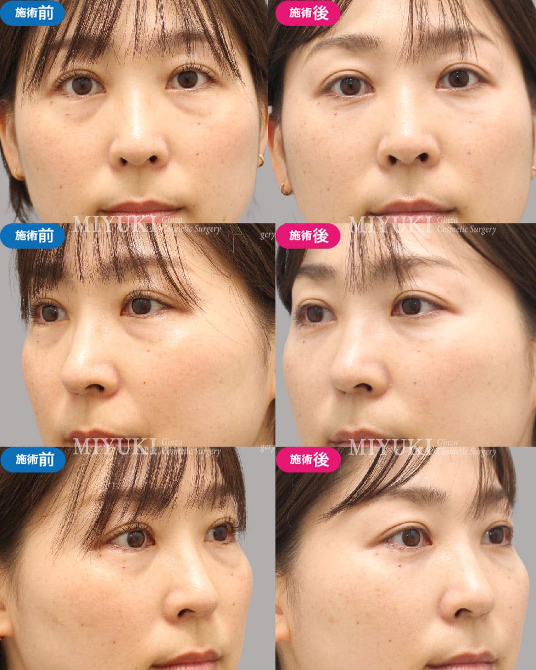 目の下のくま症例480の治療画像