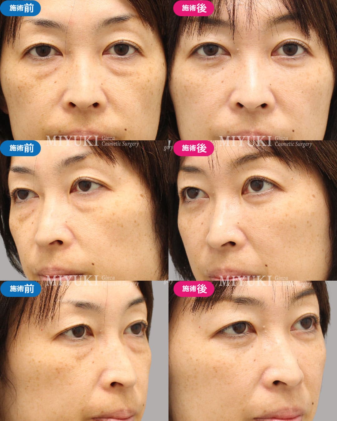 目の下のくま症例481の治療画像