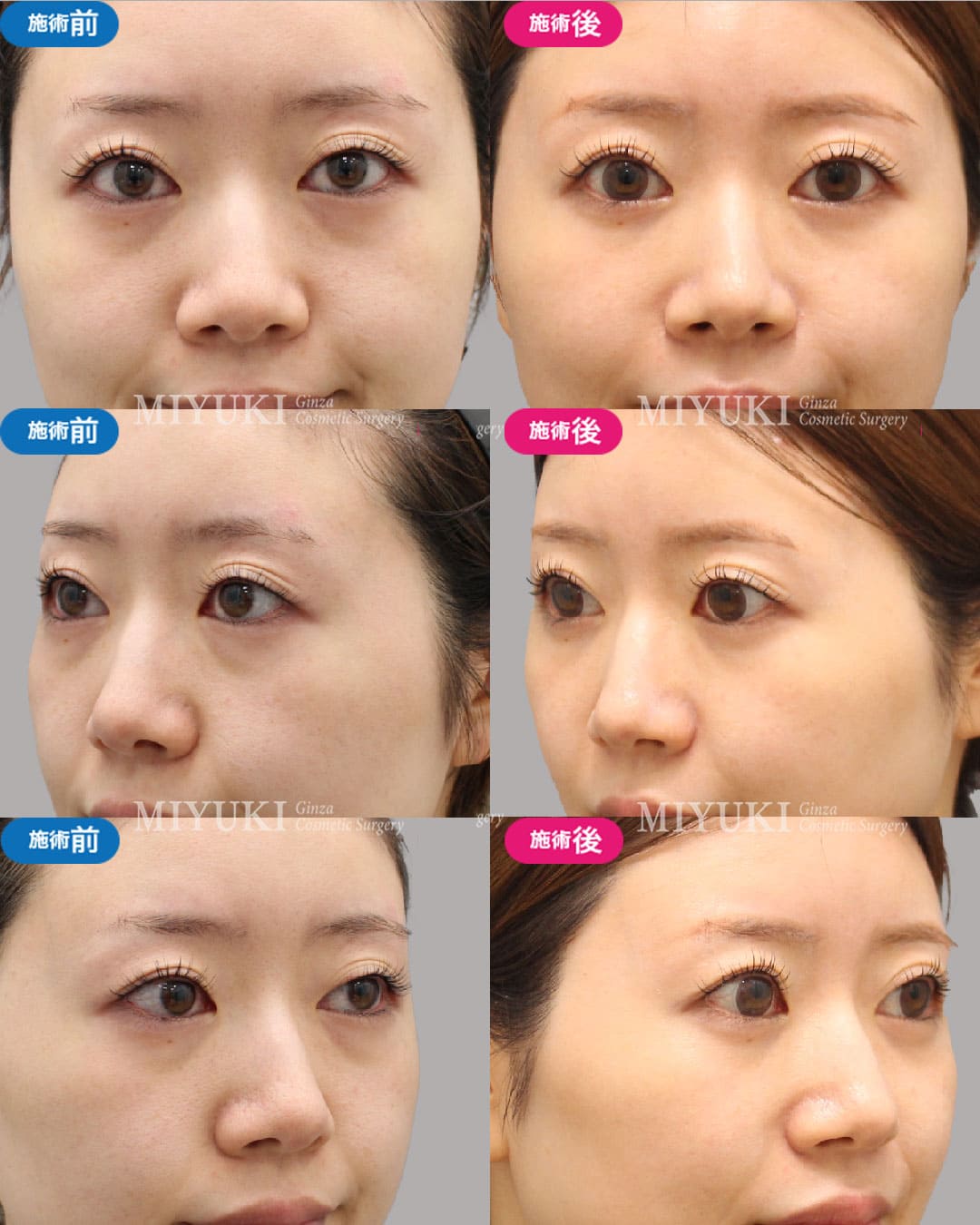 目の下のくま症例482の治療画像