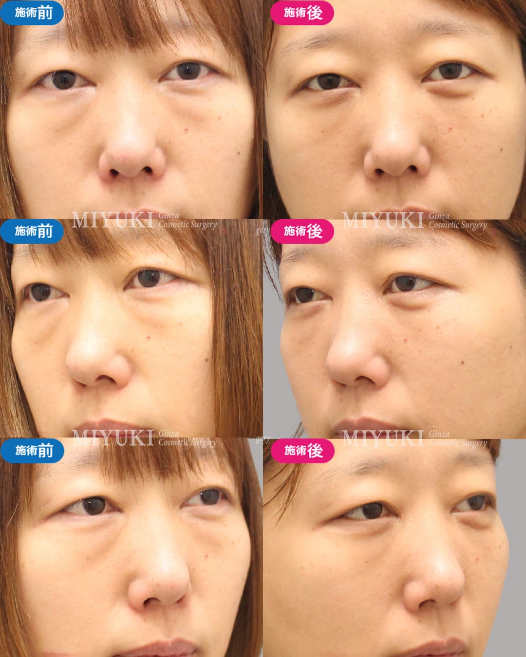 目の下のくま症例483の治療画像