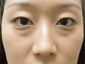 目の下のクマ・タルミ症例手術前（メイクあり）