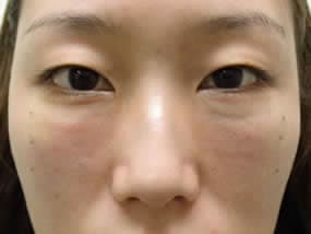 目の下のクマ・タルミ症例手術直後（メイクなし）