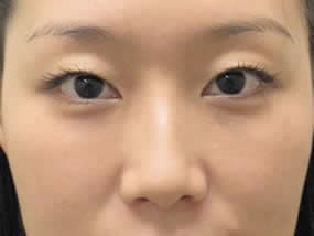 目の下のクマ・タルミ症例手術１ヵ月後（メイクあり）