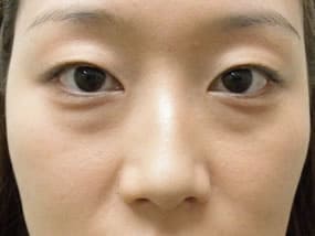 目の下のクマ・タルミ症例手術前
