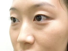 目の下のクマ・タルミ症例手術前
