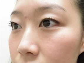 目の下のクマ・タルミ症例手術３ヶ月後