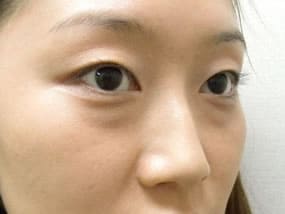 目の下のクマ・タルミ症例手術前