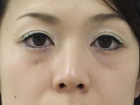 目の下のクマ・タルミ症例手術前（メイクあり）