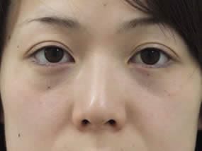 目の下のクマ・タルミ症例手術直後（メイクなし）