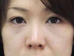 目の下のクマ・タルミ症例手術２日後（メイクあり）