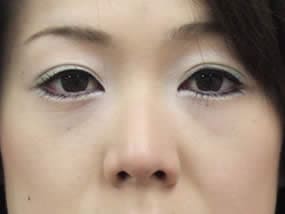 目の下のクマ・タルミ症例手術１週間後（メイクあり）