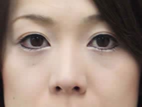 目の下のクマ・タルミ症例手術２週間後（メイクあり）