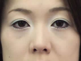 目の下のクマ・タルミ症例手術１ヵ月後（メイクあり）