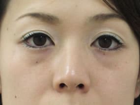 目の下のクマ・タルミ症例手術前