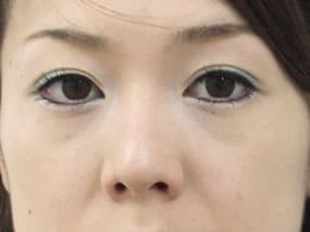 目の下のクマ・タルミ症例手術３ヶ月後