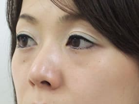 目の下のクマ・タルミ症例手術前