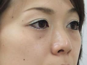 目の下のクマ・タルミ症例手術前