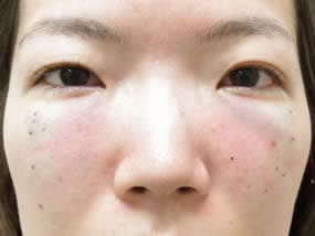目の下のクマ・タルミ症例手術直後（メイクなし）