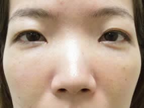 目の下のクマ・タルミ症例手術１週間後（メイクあり）