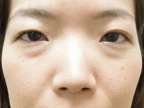 目の下のクマ・タルミ症例手術前