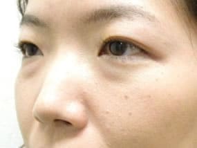 目の下のクマ・タルミ症例手術前