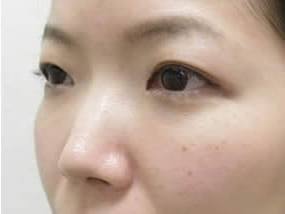 目の下のクマ・タルミ症例手術３ヶ月後