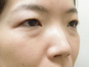 目の下のクマ・タルミ症例手術前