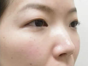 目の下のクマ・タルミ症例手術３ヶ月後