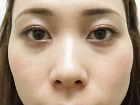 目の下のクマ・タルミ症例手術前