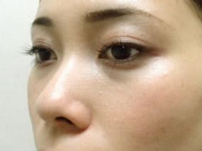 目の下のクマ・タルミ症例手術前